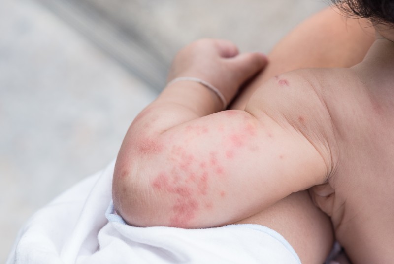 If You Have Baby Rash, Don't Baby It