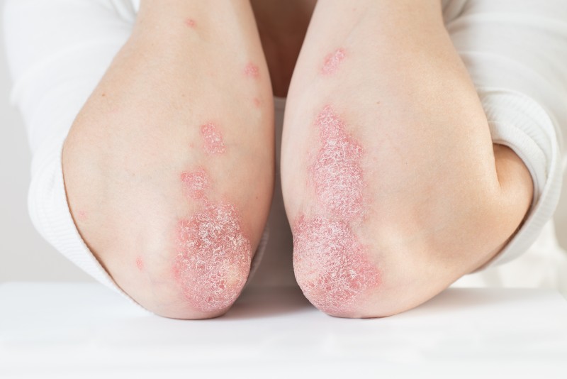 Psoriasis Awareness Month: Four Supplements That Can Help