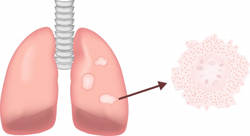 Six Supplements That Could Address Sarcoidosis