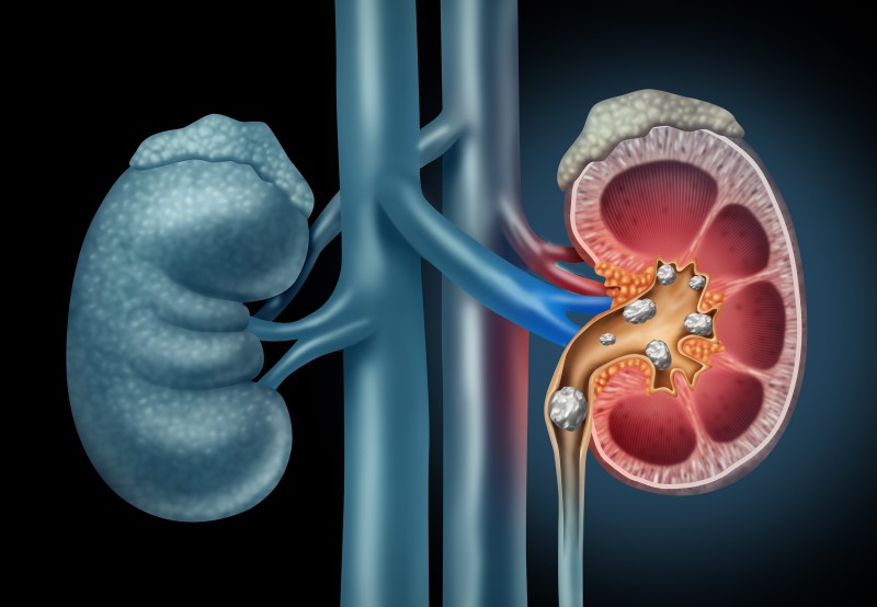 Supplements That Could Stifle Kidney Stones