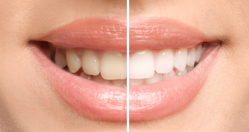 Try These If You Want Healthy, White Teeth