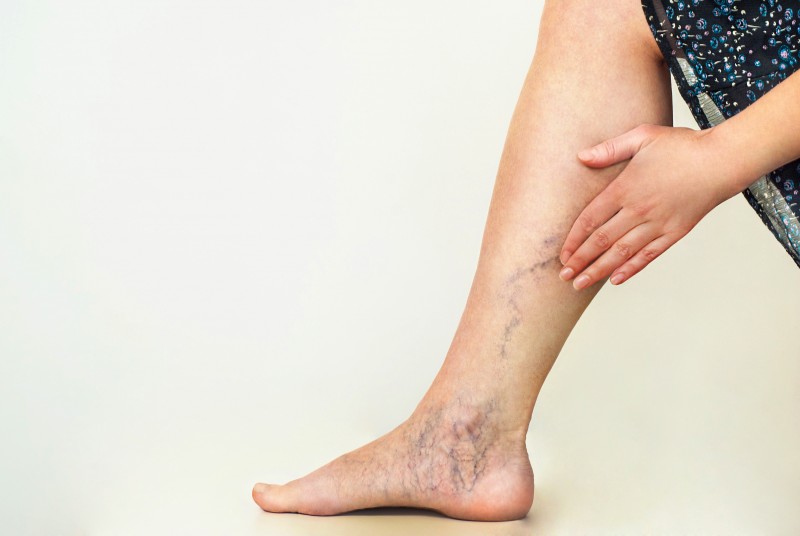 Try These Remedies If Vexed By Varicose Veins