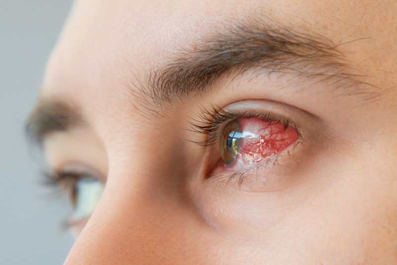 What Is Pink Eye, and What Can Be Done About It?