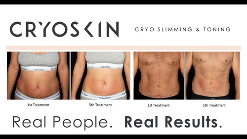 total.sculpting Check this CRYOSKIN TONING transformation and these  legs!🔥😮 This is Cryoskin's power: diminish cellulite, tighte