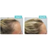 Day 0 and Day 90 photos of a hairline