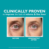 Before and after under-eye photos showing volume and fine lines
