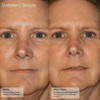 Before and after photos of a woman's face after 12 weeks