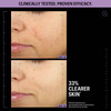 Day 1 and day 14 skin clarity comparison, Allies of Skin clinical results