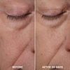 Before and after 30 days close-up of the under-eye area