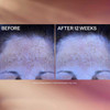 Super-C Night before and after 12 weeks forehead lines graphic