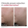 Before and after photos of skin for visible blemishes