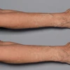 Forearm skin close-up, fragile thin skin therapy graphic