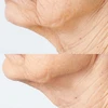 Neck and jawline before and after Sub-D Neck firming comparison