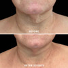 Neck before and after 30 days of using the cream
