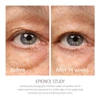 epionce Renewal Eye Cream before and after 14 weeks eye area photos