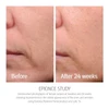 epionce Renewal Facial Lotion before and after 24 weeks cheek photos