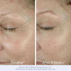 Obagi ELASTIderm before and after 8 weeks eye area photos