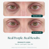 Eyes at baseline and after 4 months using Marini Luminate Eye Gel
