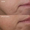 Before and after 8 weeks close-up photos of smile lines