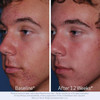 Obagi CLENZIderm before and after 12 weeks acne photos, male profile