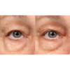 Before and after close-up of eye area with reduced under-eye puffiness