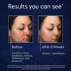 Before and after 8 weeks photos of a woman using HydraMatte