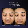 Baseline and after 24 weeks face photos, smooths lines and wrinkles by 40% text