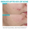Before and after 4 weeks cheek photos, reduce up to 45% of acne, no retouching text