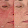 Before and after 28 days: cheek redness visibly reduced