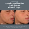 Before and after 7 days photos of cheek and jawline firmness