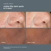 Before and after 5 uses, visibly lifts dark spots on nose and cheek skin
