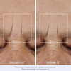 Forehead lines at baseline and week 8