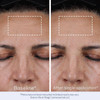Forehead at baseline and after a single application