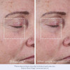 Eye area at baseline and after a single application