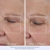 Baseline and after 12 weeks close-up of eyelid and cheek area