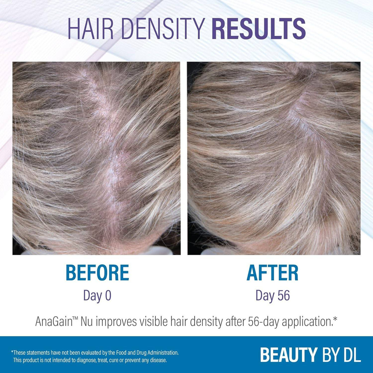 Scalp before and after day 56 hair density photos
