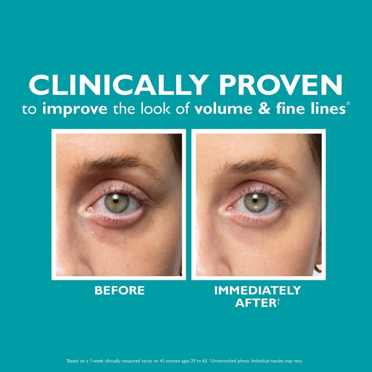 Before and after under-eye photos showing volume and fine lines