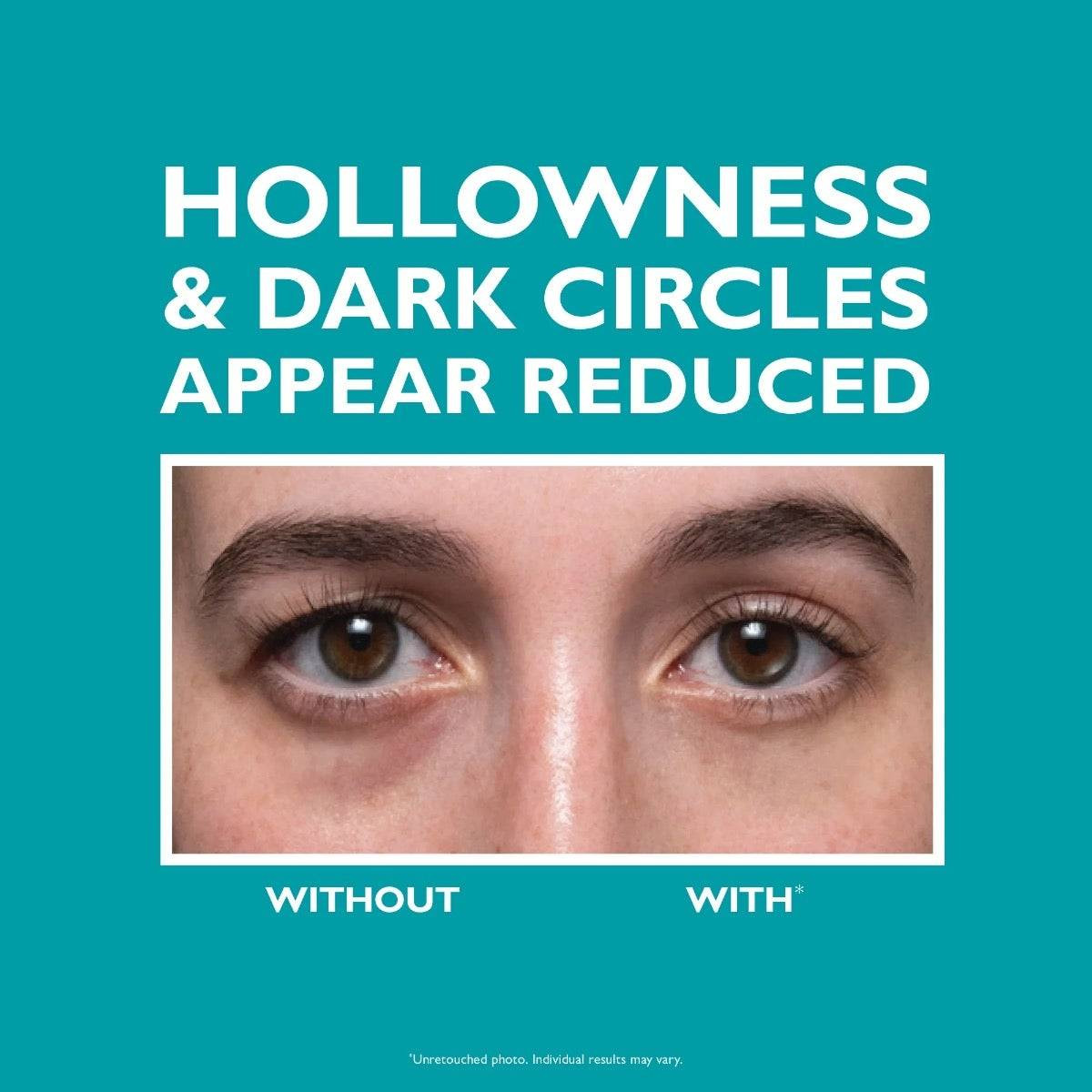 Without and with photos of under-eye hollowness and dark circles
