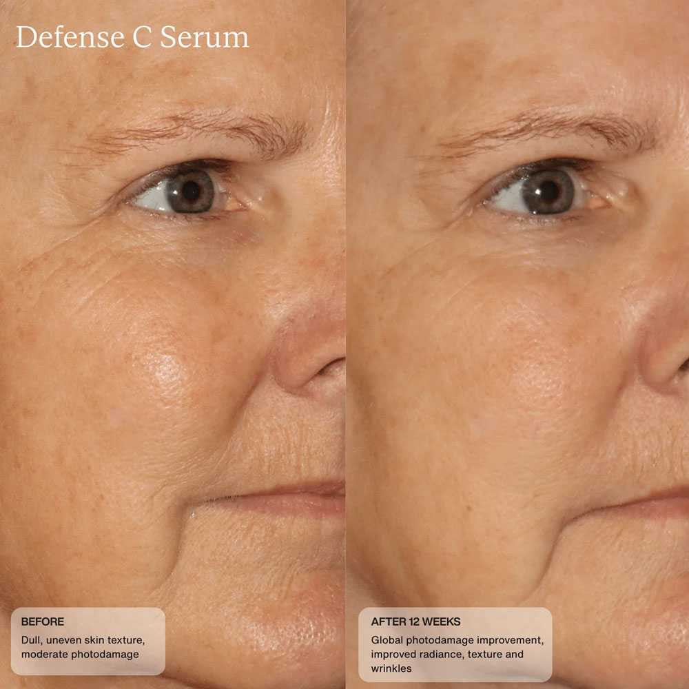 Before and after close-up of the eye area after 12 weeks