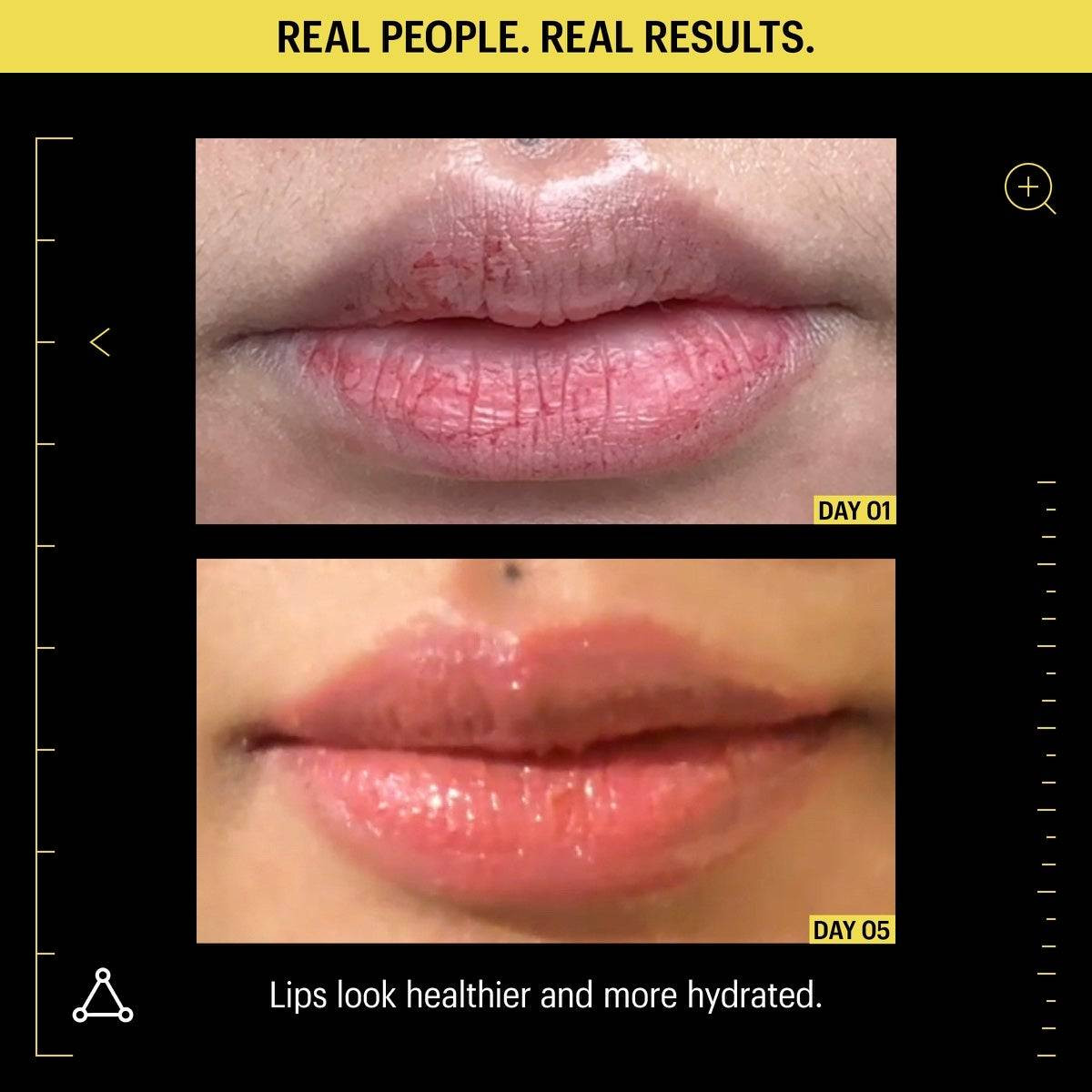 Lips before and after on day 1 and day 5, real people real results