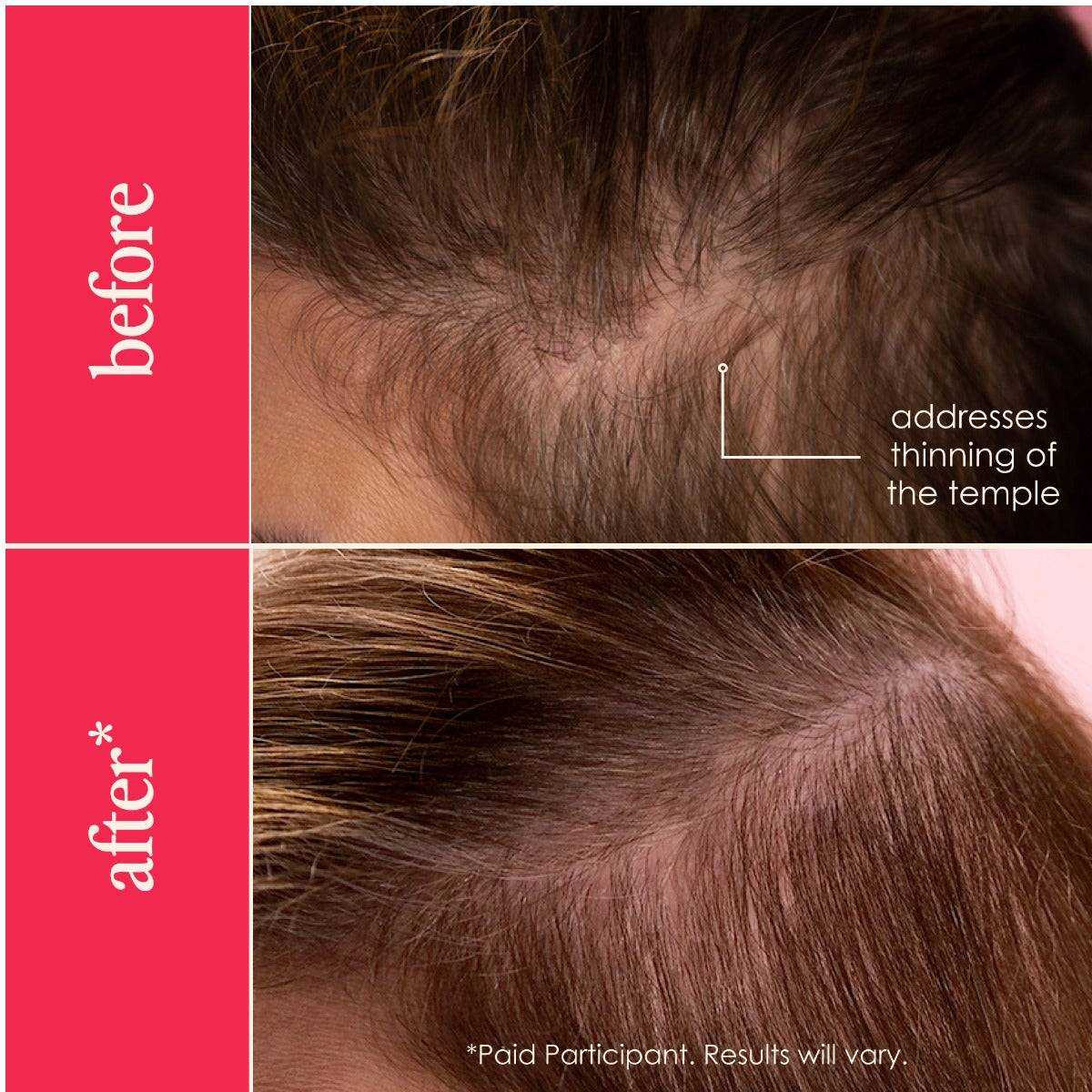 Hair Enhancing Serum before and after temple thinning density comparison