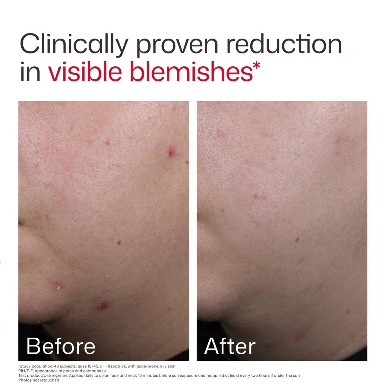 Before and after photos of skin for visible blemishes