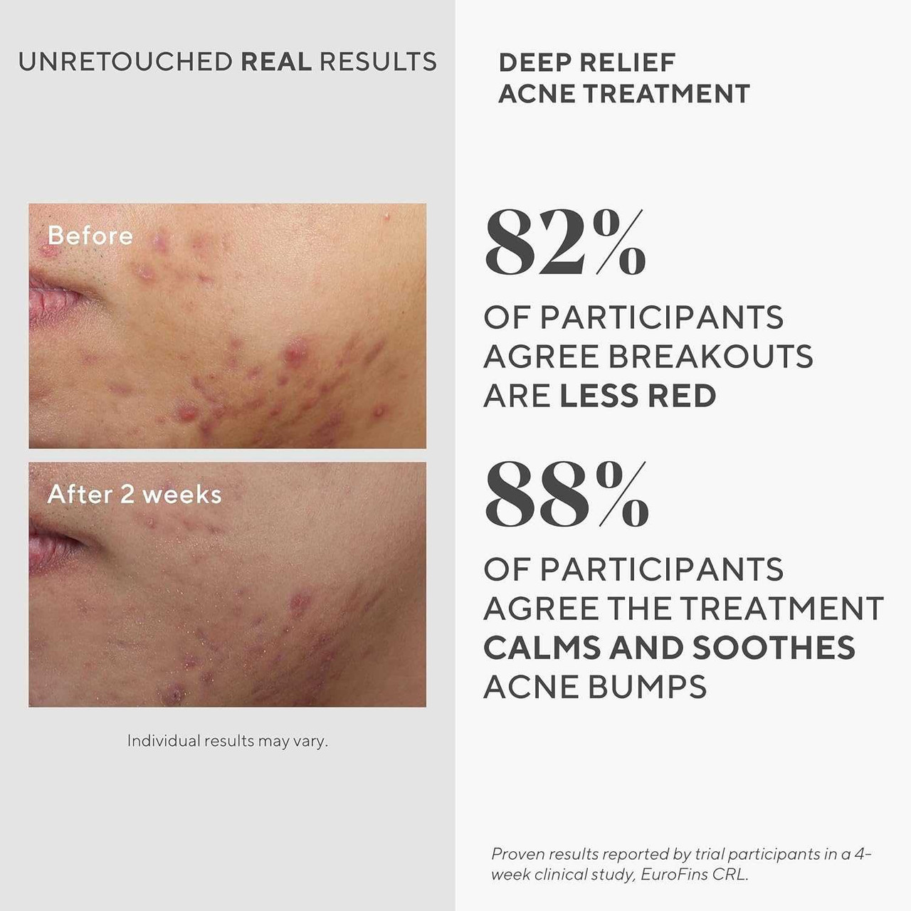 Murad Deep Relief Acne Treatment M53919 48