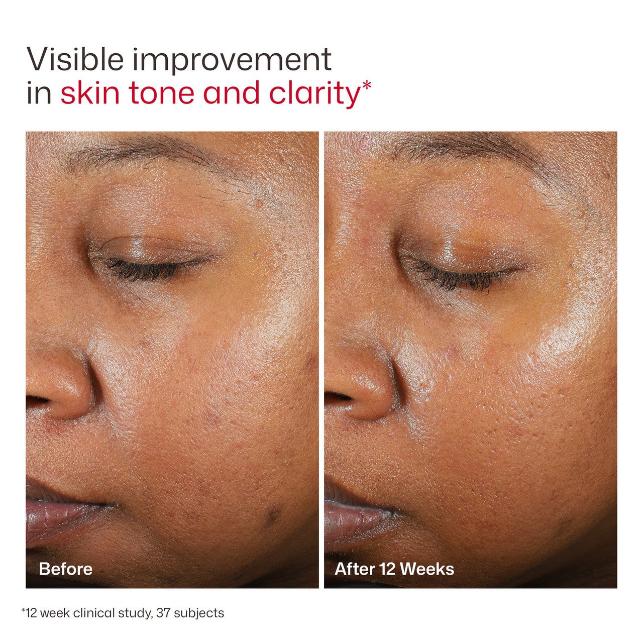 EltaMD UV Clear before and after 12 weeks photos of skin tone