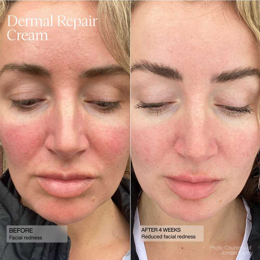 Senté Dermal Repair Cream before and after 4 weeks photos of facial redness