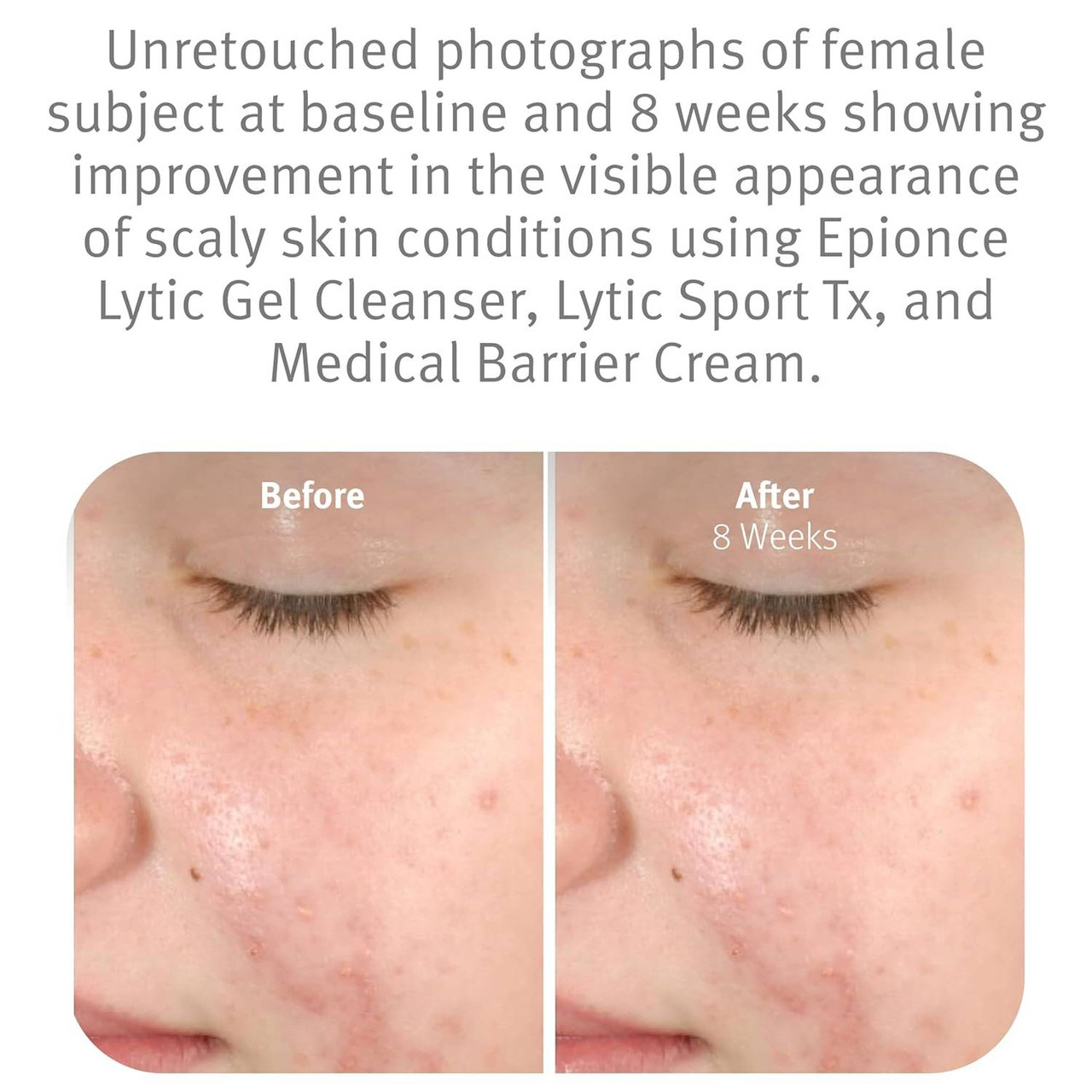 epionce Lytic Gel Cleanser at BeautifiedYou.com