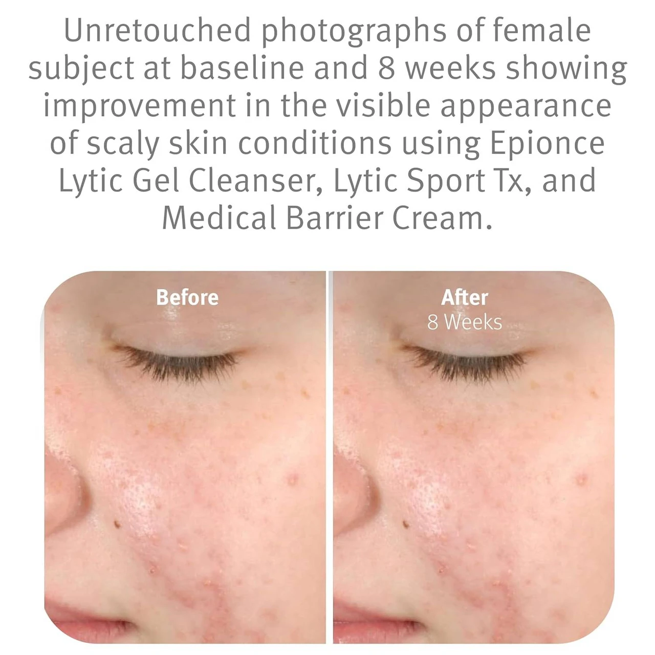 epionce Lytic Gel Cleanser before and after 8 weeks skin photos