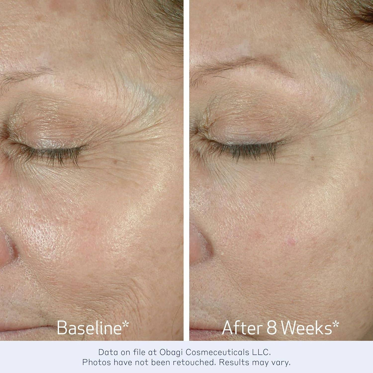 Obagi ELASTIderm before and after 8 weeks eye area photos