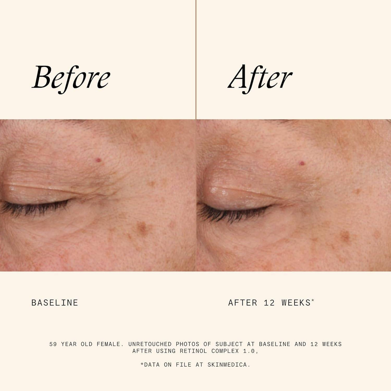 SkinMedica Retinol Complex before and after 12 weeks eye area photos