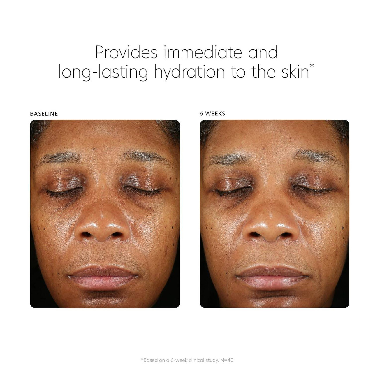PCA Skin Hyaluronic Acid Boosting Serum baseline and 6 weeks face photos